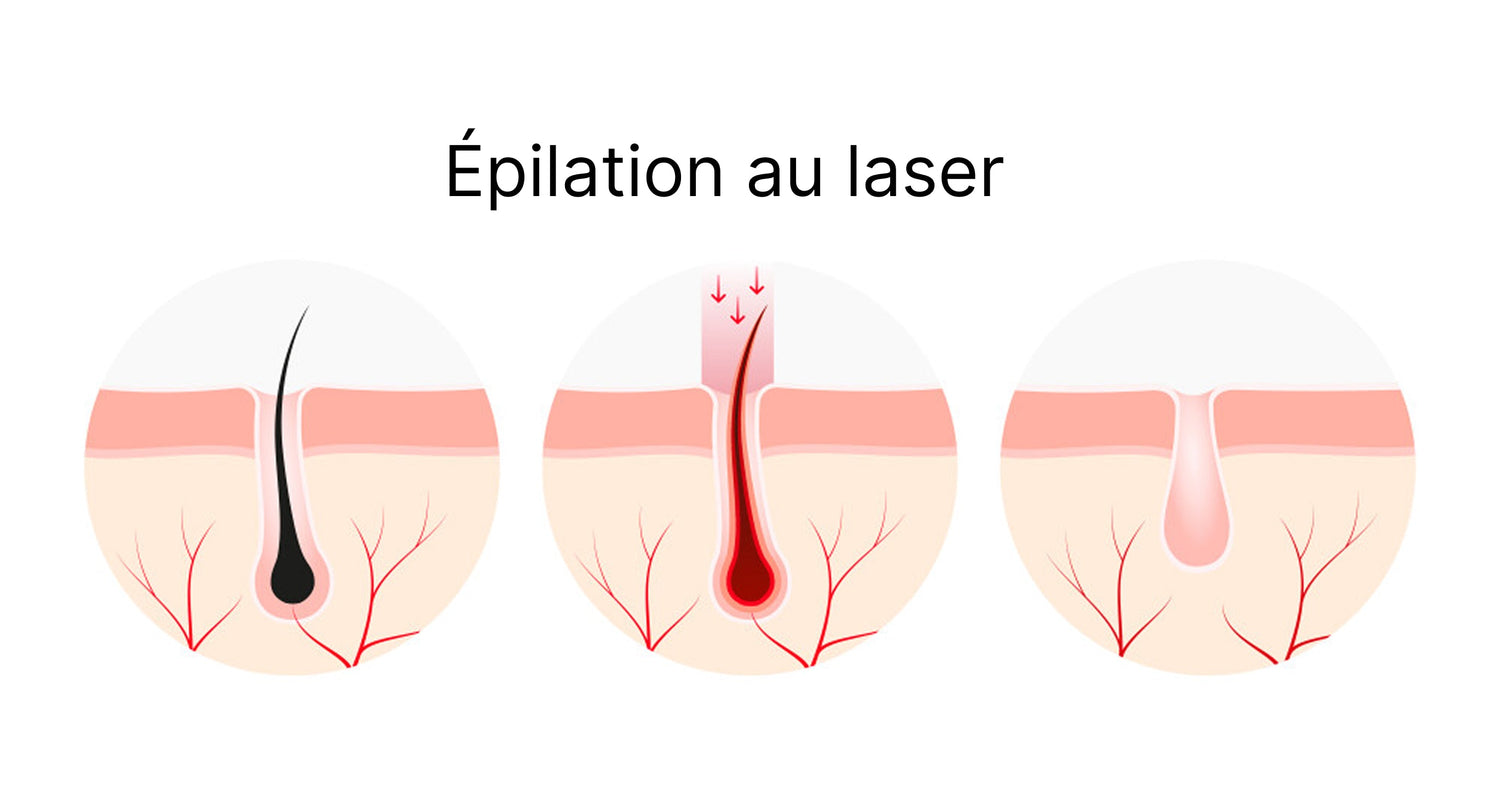IPL vs. Laser en institut : Quelle est la meilleure solution ?