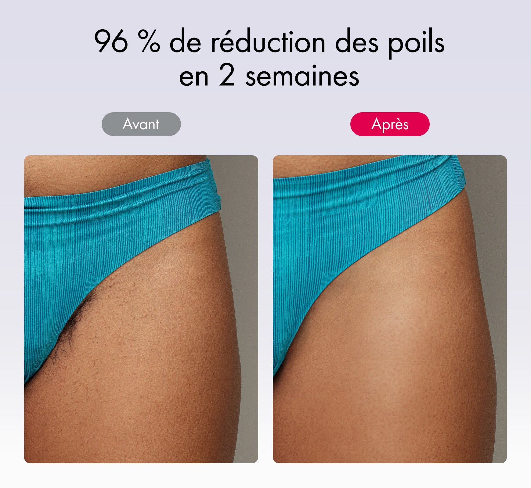 L'épilation efficace et durable. Les résultats visibles du maillot après seulement 2 semaines avec Ulike Air 10.